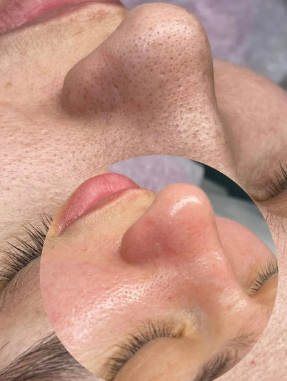 Monordic Ултразвучен Пилинг Уред